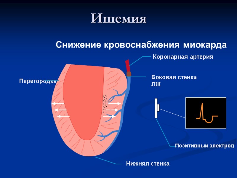 Ишемия Коронарная артерия Боковая стенка ЛЖ Перегородка Нижняя стенка Снижение кровоснабжения миокарда Позитивный электрод